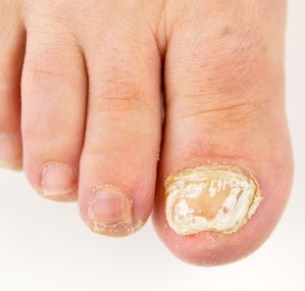 Nail Fungus