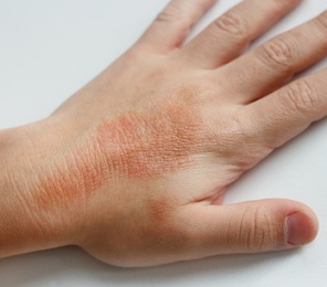skin rash from mold